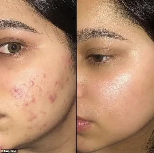 Salicylic Acid 2% Acne Serum